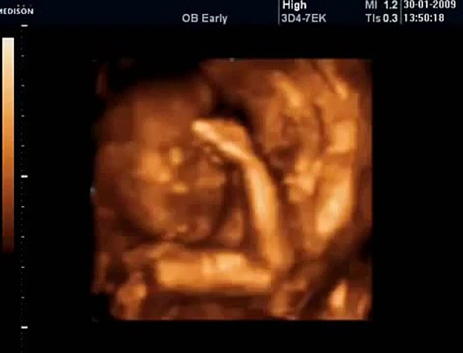 27 Haftalık Gebelik Bebek Ultrason Görüntüsü