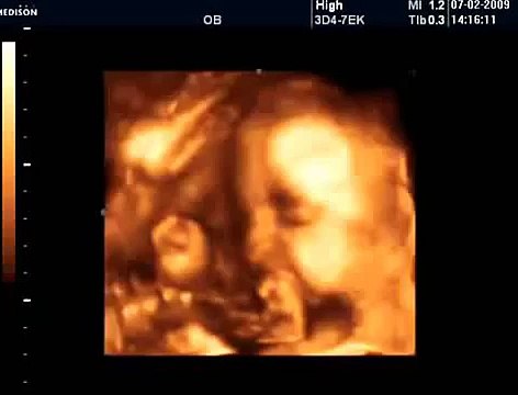 28 Haftalık Gebelik Bebek Ultrason Görüntüsü