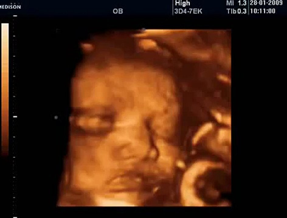 32 Haftalık Gebelik Bebek Ultrason Görüntüsü