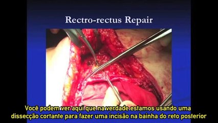 Revisão de técnicas de cirurgia de Hernia Ventral aberta
