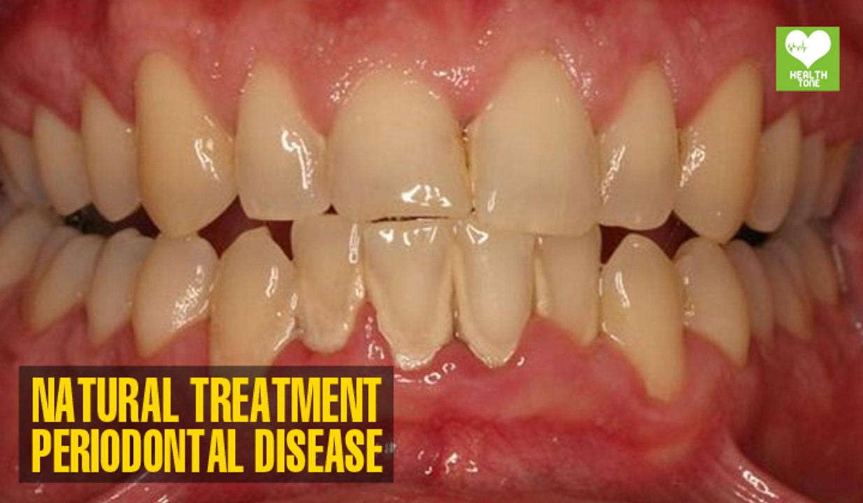Periodontal (Gum) Disease - How To Cure Naturally | Health Tips | Education