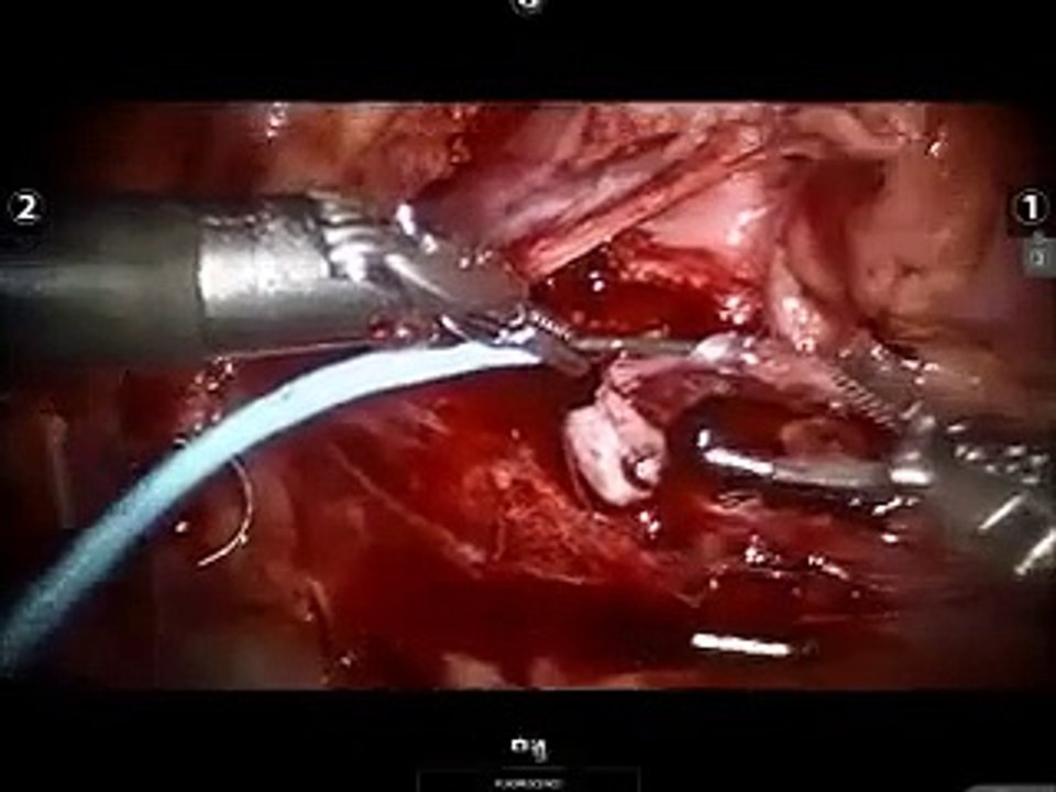 UPJ Obstruction and Kidney Stone Removal.  All Rights Reserved by the Urology Group 2013.