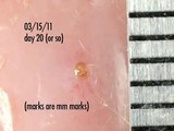 botfly larva in my ankle - days 20-23 update
