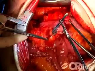 Open Colectomy without Sutures or Significant Blood Loss