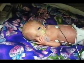 Ребенок родился на 15 неделе беременности