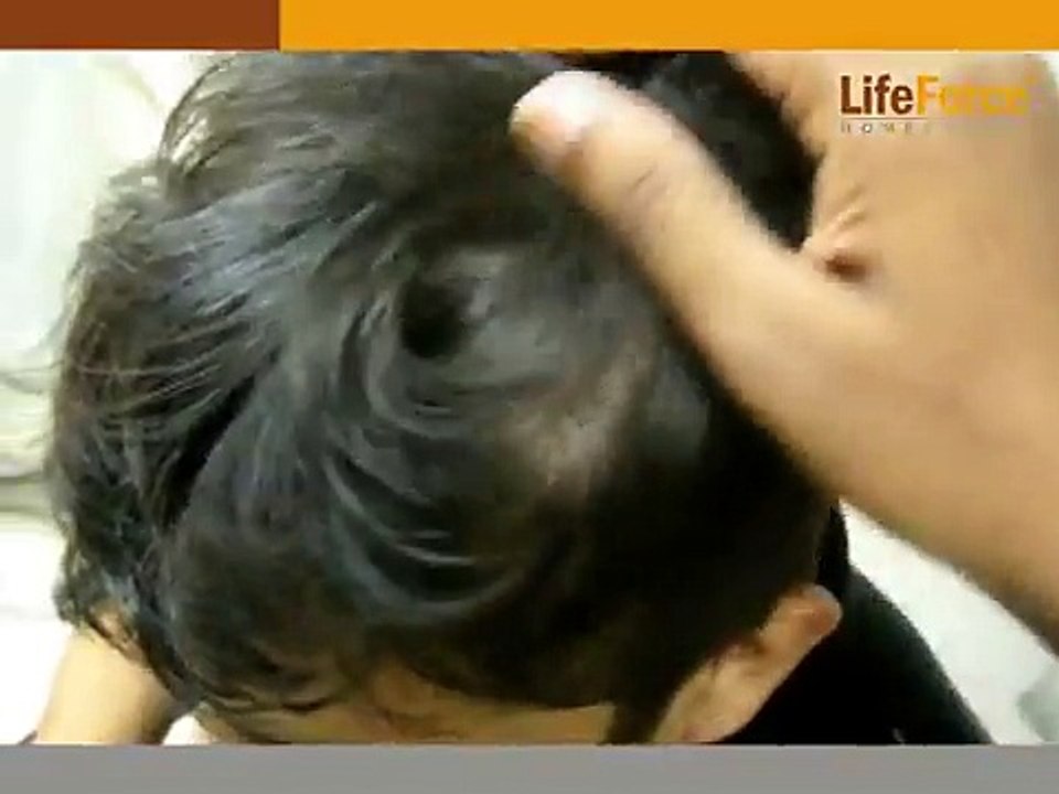 Scalp Psoriasis