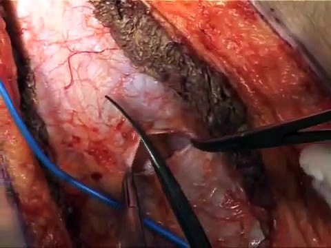 Liver Transplantation Techniques For The Surgical Management Of Renal Cell Carcinoma