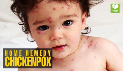 Chickenpox (चेचक) - Home Remedies | Health Tips | Educational Video