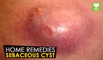 Sebaceous Cyst - Home Remedies | Health Tone Tips