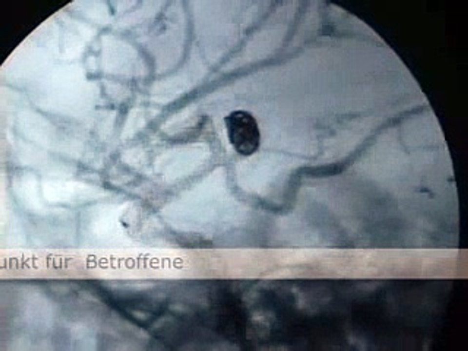 Aneurysma/Hirnaneurysma Coil Embolisation