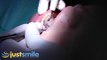 Extreme Dental Cleaning - Just Smile Dental Hygiene Toronto