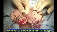 Osada Procedure for Massive Adenomyosis: Preserving Uterus