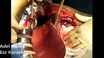 Bloodless Liver Surgery in Living Donor Liver Transplants