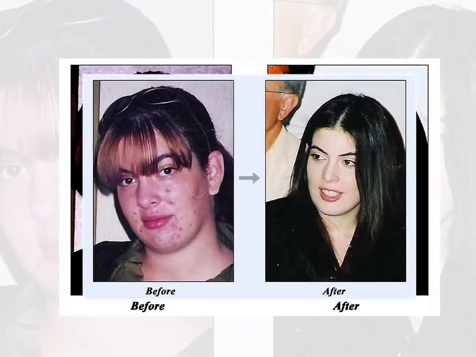 Acne No More _ A New Powerful Acne Treatment System _ Health Review Center