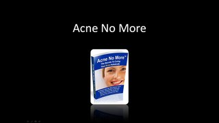Mike Walden's Acne Treatment Program Acne No More Review
