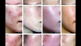 My Acne No More review !