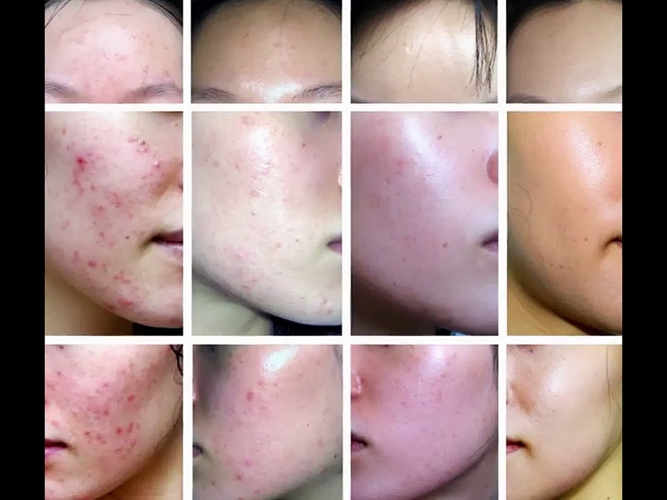 My Acne No More review !