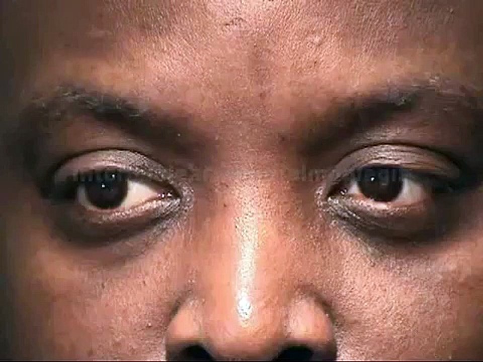 Internuclear Ophthalmoplegia