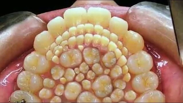Doctors remove 232 TEETH from boy's MOUTH in a Record Breaking operation