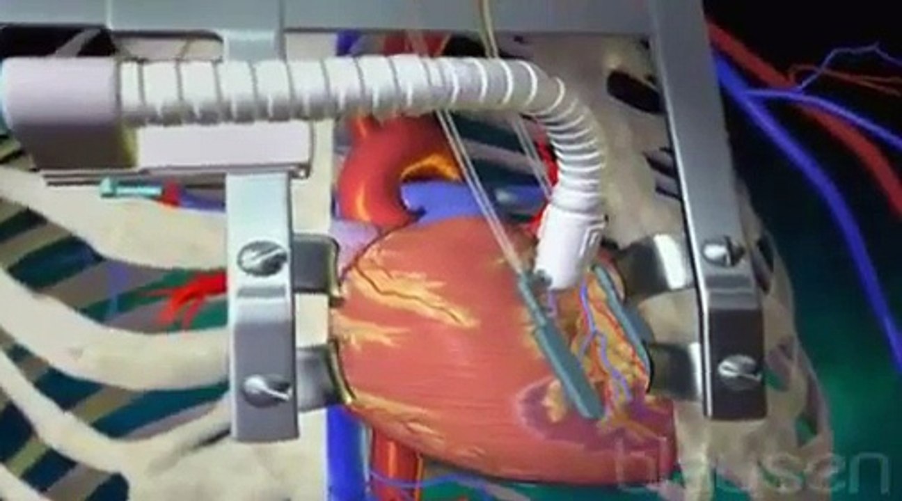 OPCAB : Pontage coronarien à cœur ouvert