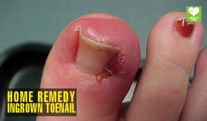 Home Remedies To Get Rid Of Ingrown Toenail | Health Tips | Educational Video