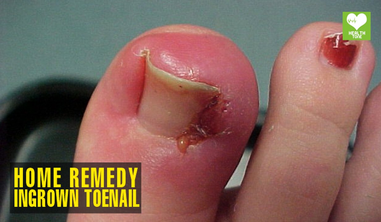 Home Remedies To Get Rid Of Ingrown Toenail | Health Tips | Educational Video