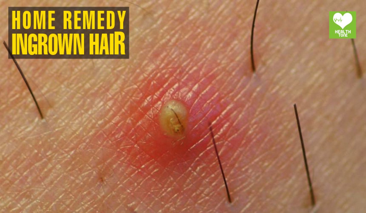 Ingrown Hair - Home Remedies | Health Tips | Educational Video