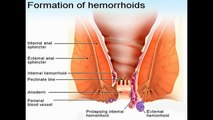 Hemorrhoids Home Treatment - Relief Recipes