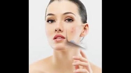 Know About Best Solution for Pimples - Solution for Acne