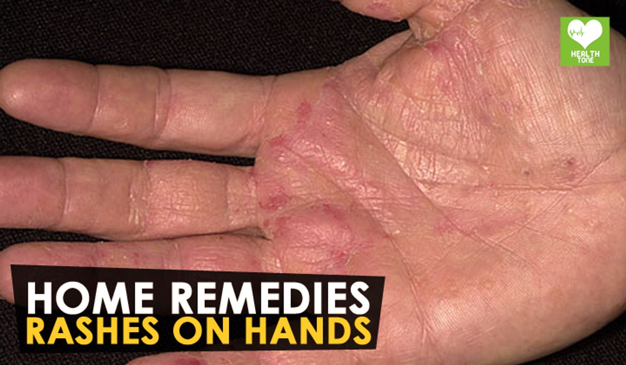 Rashes On Hands - Home Remedies | Health Tone Tips