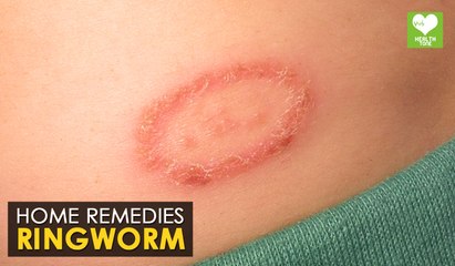 Ringworm - Home Remedies | Health Tone Tips