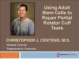 Regenexx stem cell procedure to treat shoulder rotator cuff tear