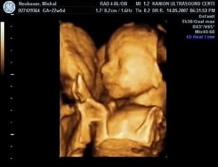 23rd week 4D Ultrasound - Amazing!