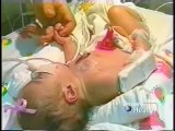 Hypoplastic Left Heart Syndrome Discovery Health Channel Super Surgery