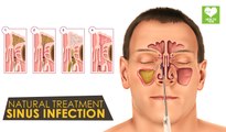 Sinus Infection Natural Treatments | Health Tips | Education
