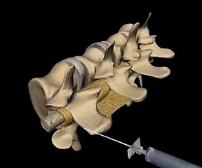 3D Animation of performing epidural anesthesia