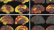 New Clues in Predicting Alzheimer's Disease
