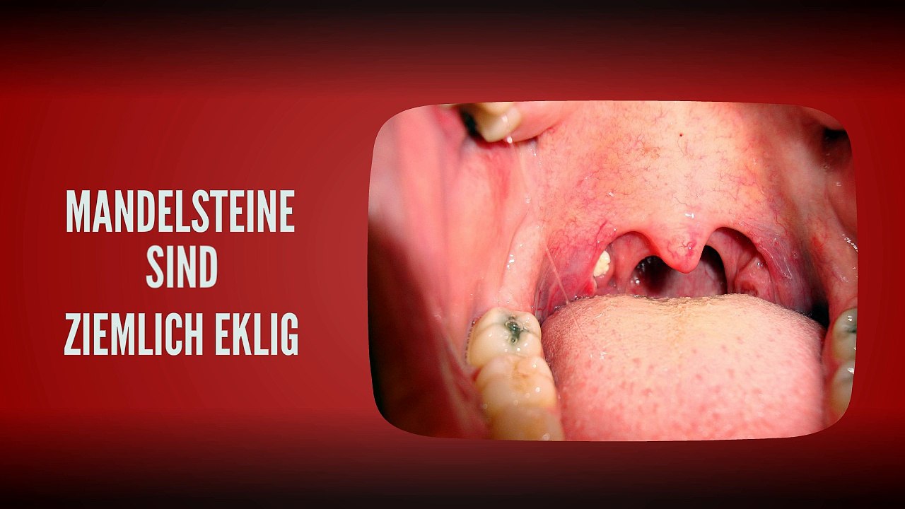 Wie Sie ihre Mandelsteine loswerden