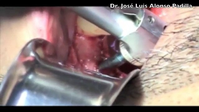 Implante Dental Bicon 36, colocación