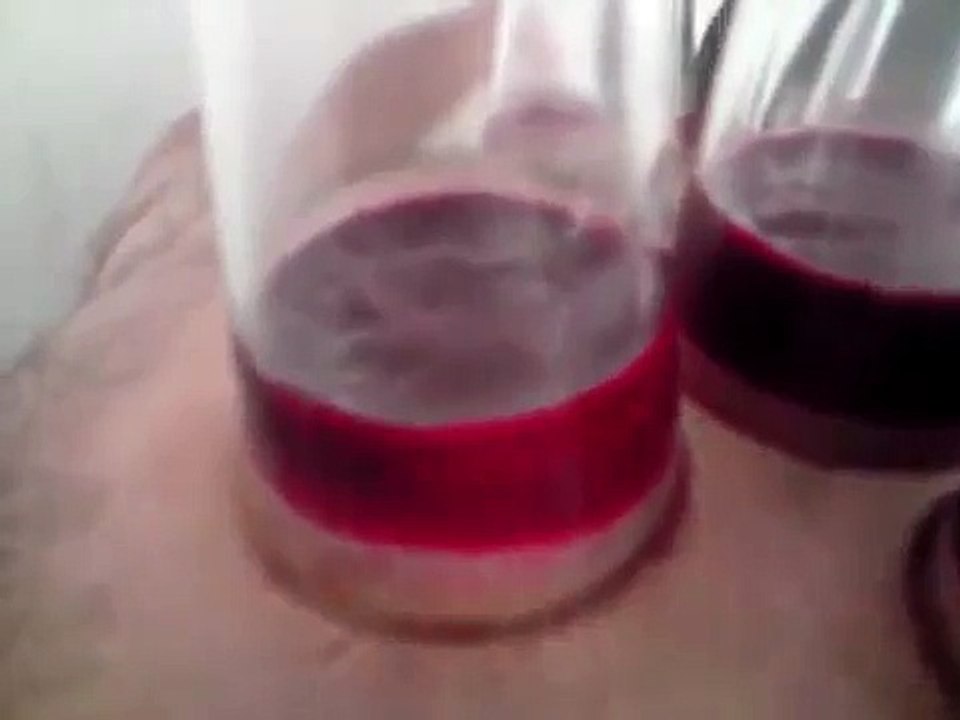 hijama(psoriasis-lower back pain -nervous breakdown).AVI