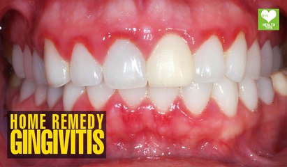Gingivitis (मसूड़े की सूजन) - Home Remedies | Health Tips | Educational Video