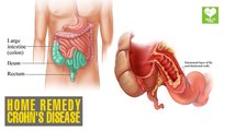 Natural Ways Stop Crohn's Disease | Health Tips | Educational Video