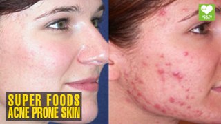 Superfoods for Acne Prone Skin | Health Tips | Educational Video