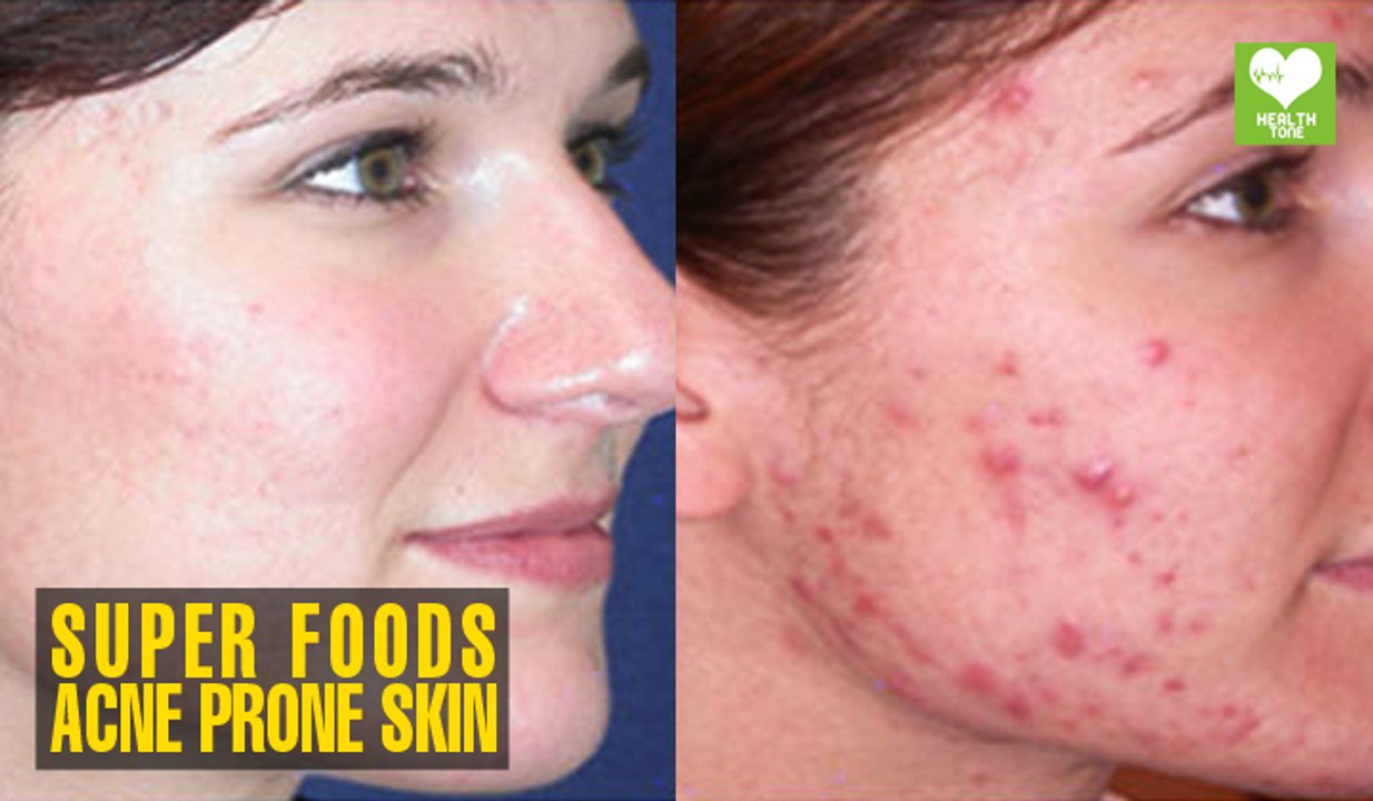 Superfoods for Acne Prone Skin | Health Tips | Educational Video