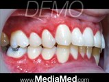 Teeth Cleaning, Brushing and Flossing-Dental