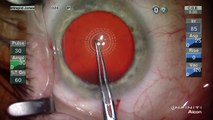 Phaco with Unanticipated Advanced Diffuse Zonulopathy