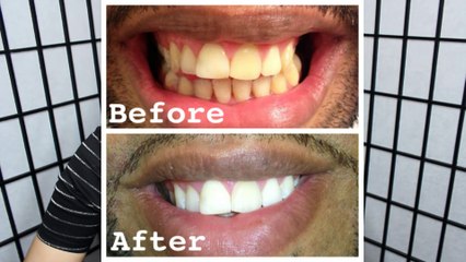 How to whiten EXTREMELY yellow teeth at home (with actual pictures)