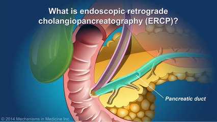 Understanding ERCP (Endoscopic Retrograde Cholangiopancreatography)