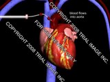 Cardiopulmonary Bypass video - Animation by Cal Shipley, M.D. Trial Image Inc.