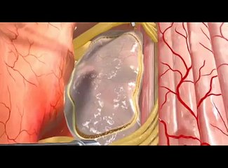 Animation - Spinal Cord Intramedullary Tumor.mov